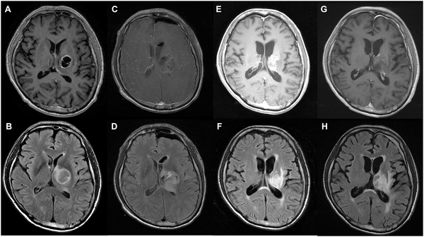 丘脑胶母GBM生存期可有多久？研究显示切除程度越高、生存期越久